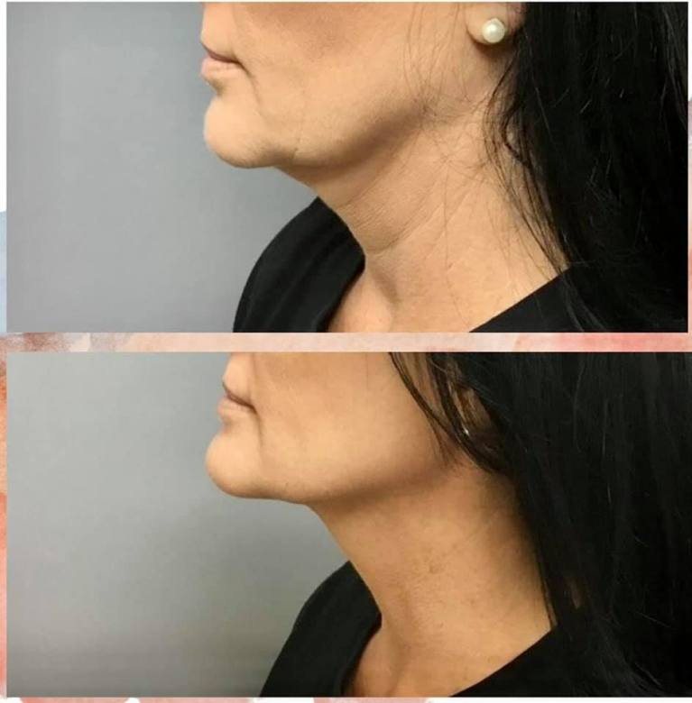 Cryotherapy Treatment with neck slimming