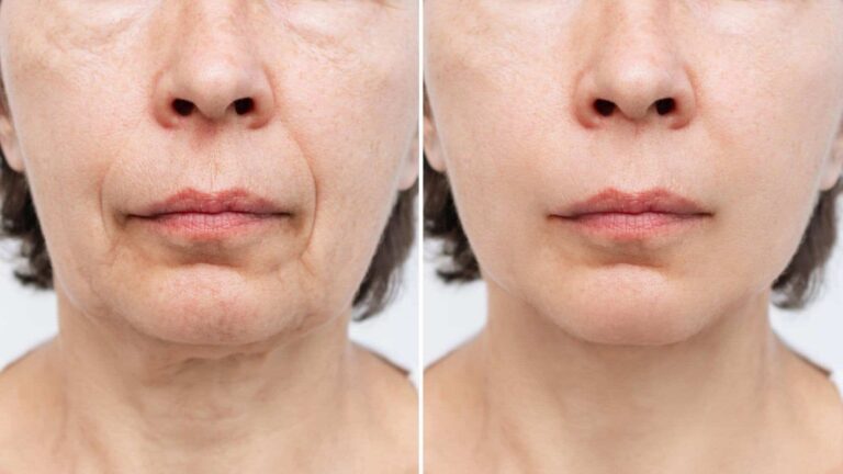 Fractional RF Treatment